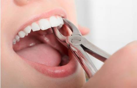 Dental Extraction