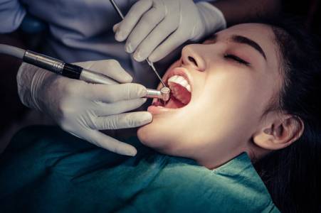 Teeth Cleaning Services in Naranpura
