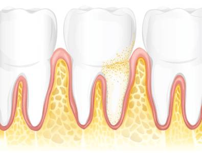 Gum Disease Ahmedabad