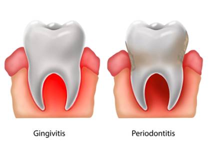 Bleeding Gum Treatment Ahmedabad
