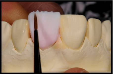 Pain Less Root Canal Treatment