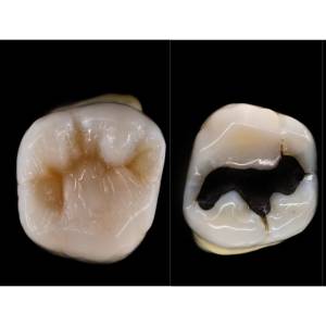 Dental Restorations (Tooth Fillings)