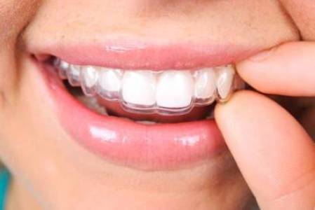 Clear Aligners