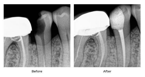 Painless Root Canal Treatment in Ahmedabad
