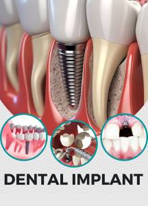 Dental Implants