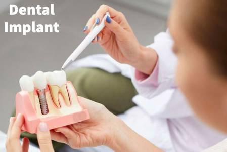 Dental Implants
