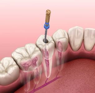 Root Canal Treatment (RCT)