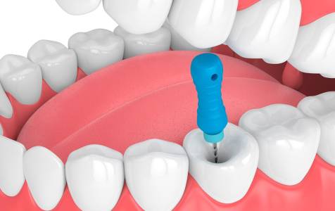 Root Canal