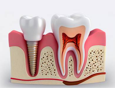 Dental Implants