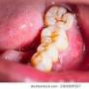 Swollen or puffy gums