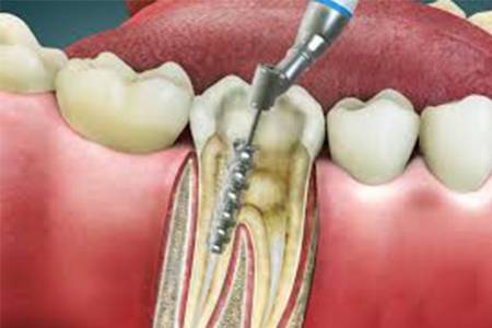 Root Canal Treatment