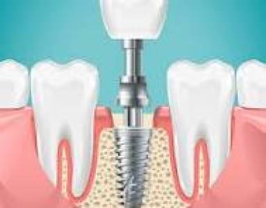 Dental Implants