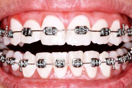 Orthodontic Treatment