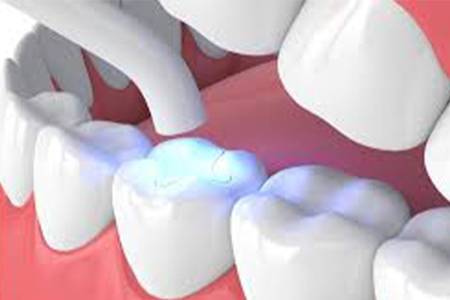 Tooth Coloured fillings