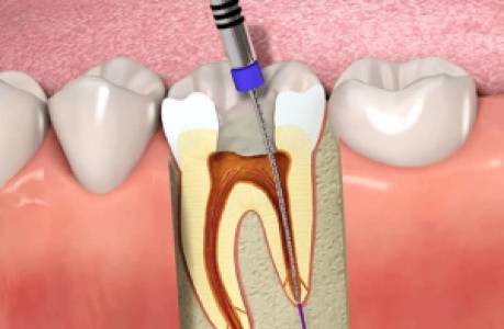 Root canal Treatments