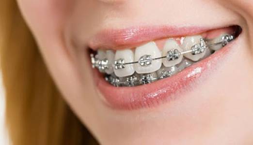 Braces / Orthodontics Treatment