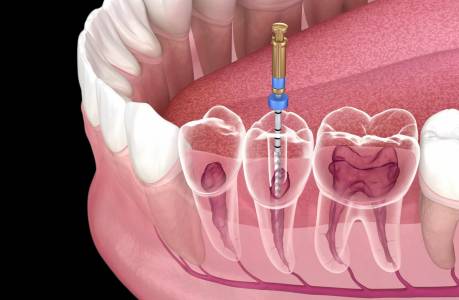 Root Canal Treatment(RCT)
