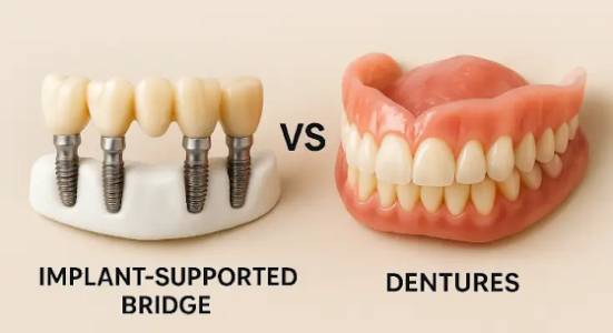 Dental Bridge vs Dentures