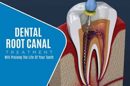 Root Canal Treatment