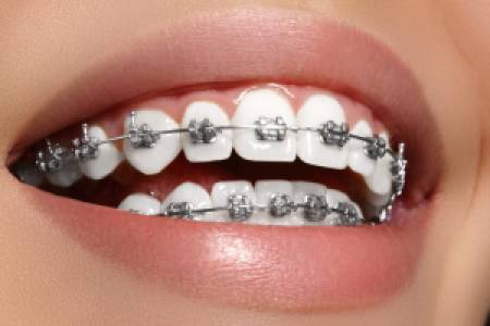 Ceramic Braces