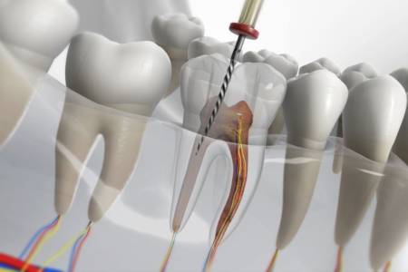 Root Canal Treatment In Faridabad