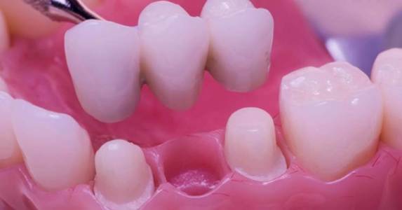 Crown & Dental Bridges Treatment