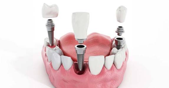 Dental Implant Treatment