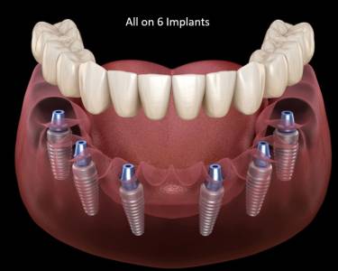 Dental Implants