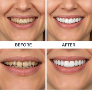 Smile Design Makeover