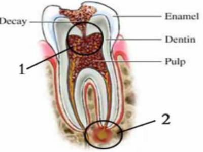 Root Canal Treatement