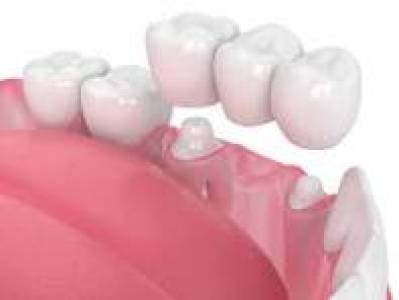 Dental Crowns And Bridge
