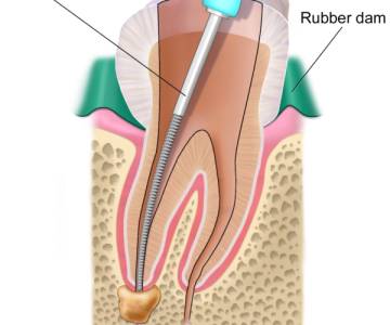 ROOT CANAL