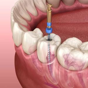 Root Canal Treatment