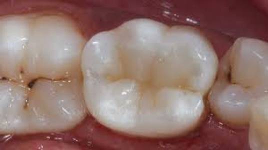 composite fillings