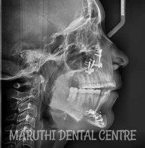 Jaw and Face correction Dentistry