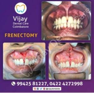 FRENECTOMY