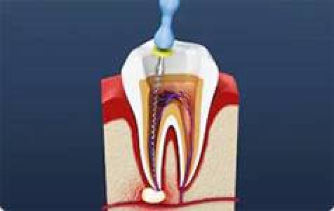 Root Canal Treatment