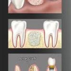 Bone Grafting