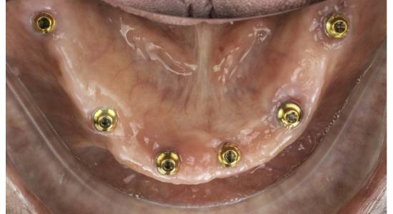 Digitally Guided Dental Implants