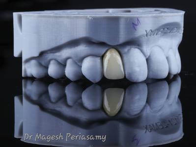 Crown and bridge treatments