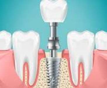 Dental implant
