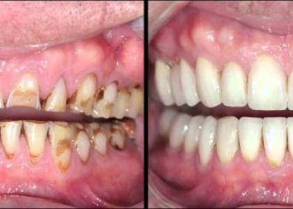 ORAL RECONSTRUCTION AND REHABILITATION