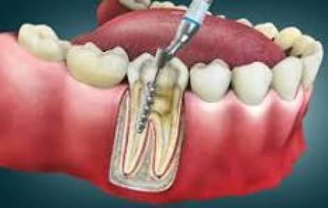 Root Canal Treatment