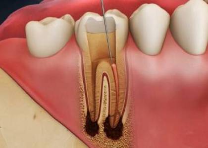 conservative dentistry treatment in