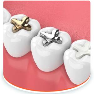 Dental Fillings
