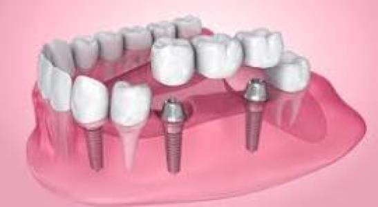 Root Canal Treatment