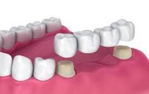 Dental Bridges